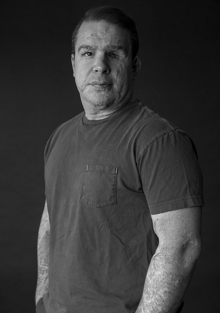 A black-and-white portrait of a man in a t-shirt, with facial scars and a missing eye