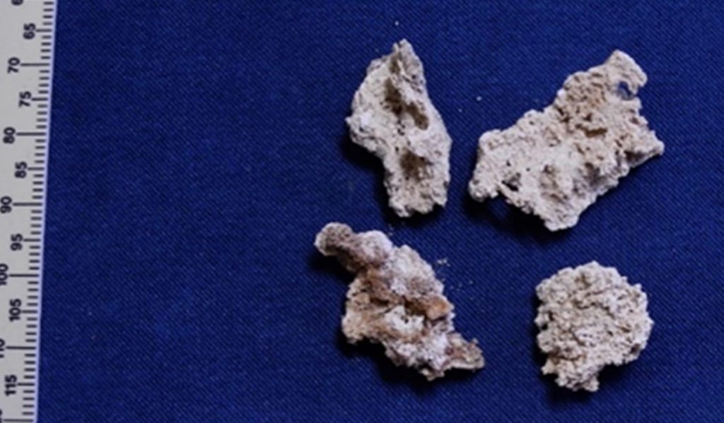 Unknown accretions found below the surfaces of some bones